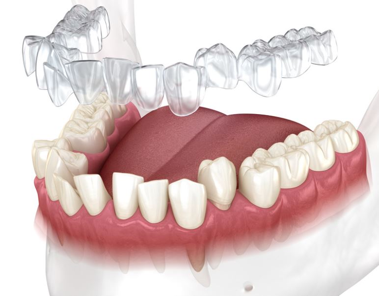¿Cómo Funciona Invisalign en la Zona Norte de Madrid?