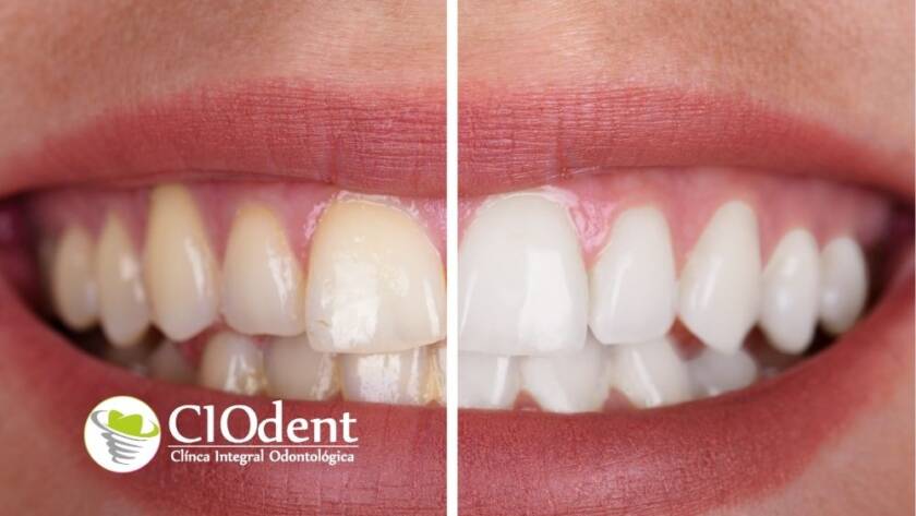 Blanqueamiento dental CIO dent