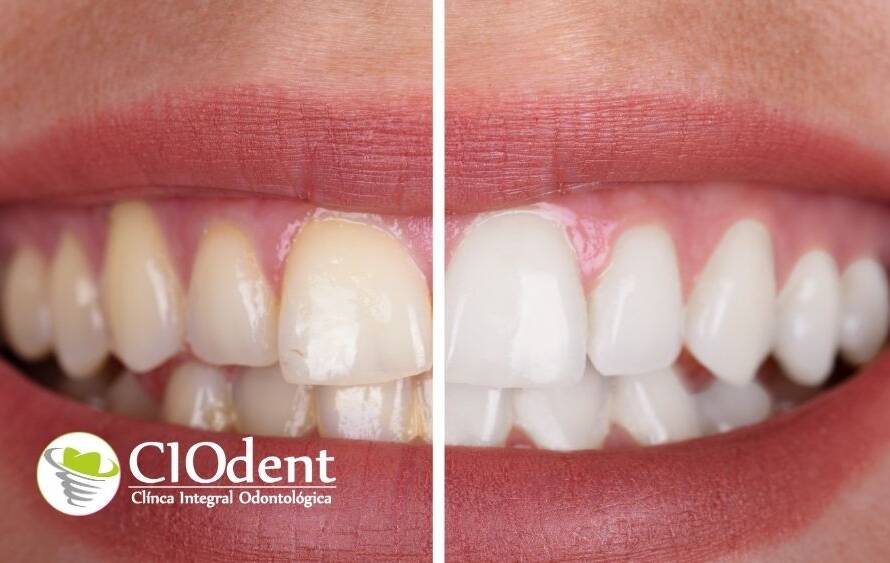 Blanqueamiento dental CIO dent