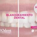 Oferta blanqueamiento dental en Madrid 20% de descuento