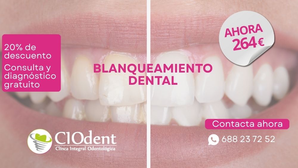 Blanquea tu sonrisa con 20% de descuento hasta fin de año | CIO dent Madrid