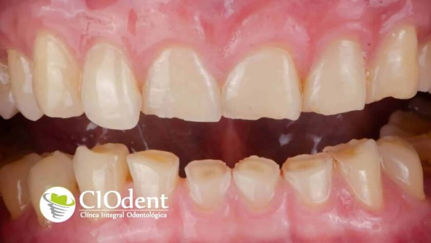 Bruxismo nocturno: cómo afecta a tus dientes y la solución con férulas de descarga