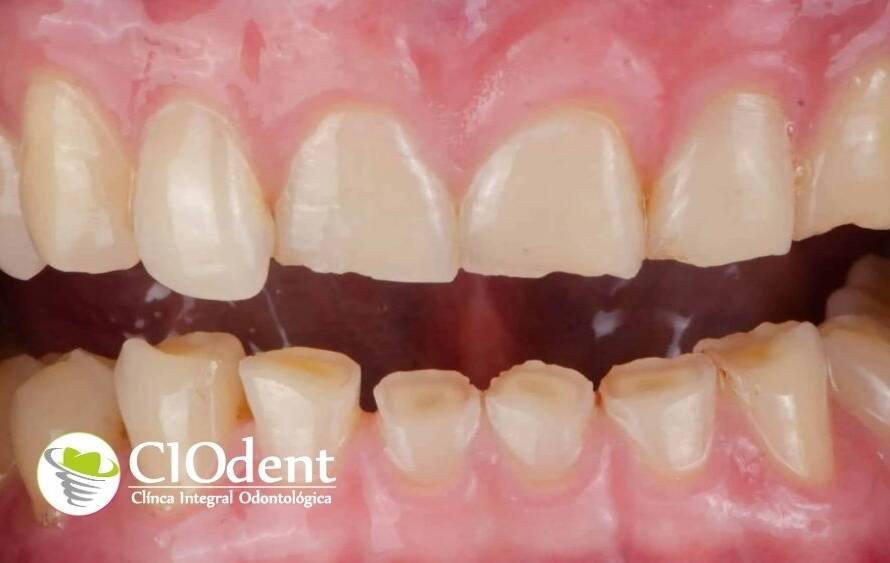 Bruxismo nocturno: cómo afecta a tus dientes y la solución con férulas de descarga