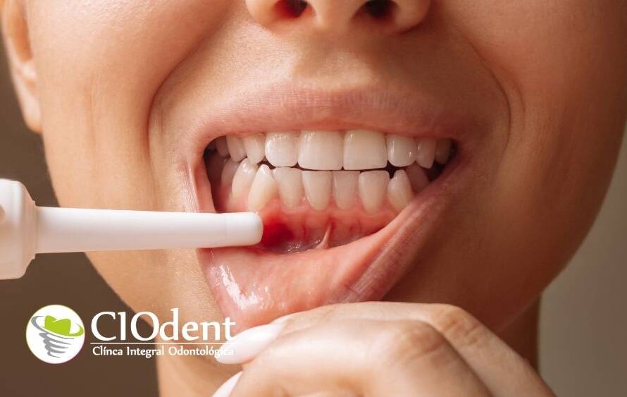Las 5 señales de alerta de la enfermedad periodontal en cio dent