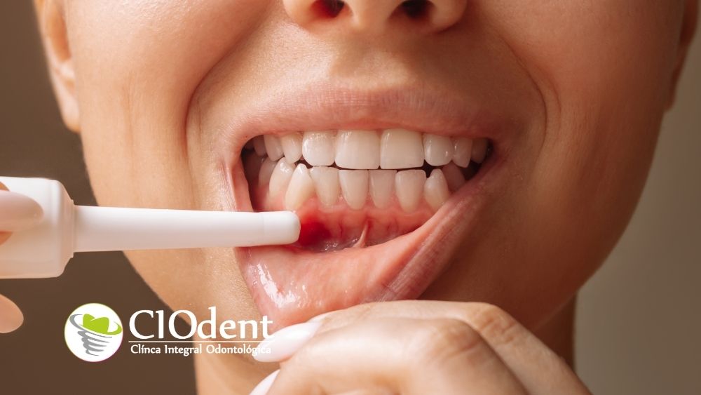 Las 5 señales de alerta de la enfermedad periodontal en cio dent
