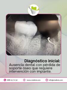implante-dental-completo-01