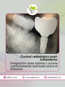 implante-dental-completo-03