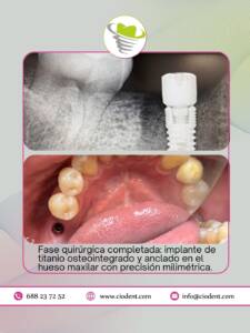 implante-dental-completo02