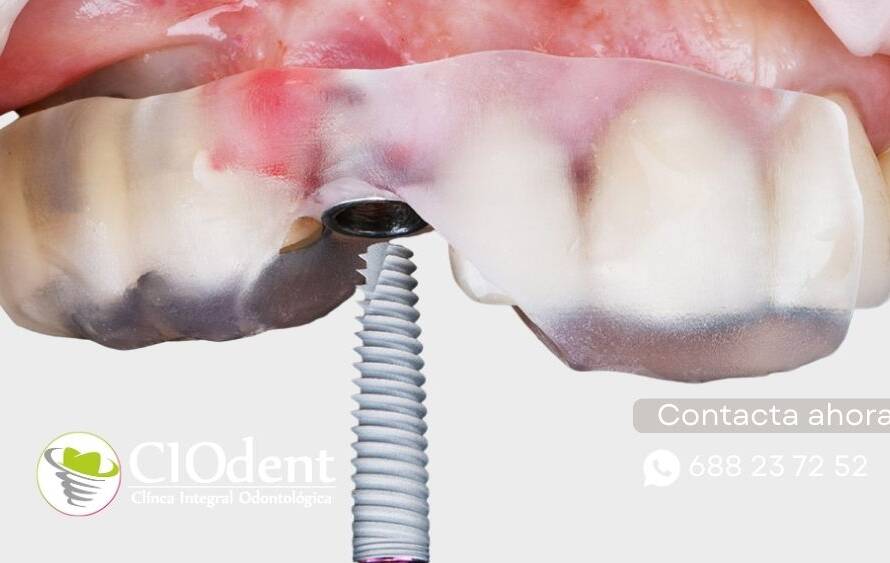 Implantes Dentales en Adultos Mayores: Mitos vs. Realidad