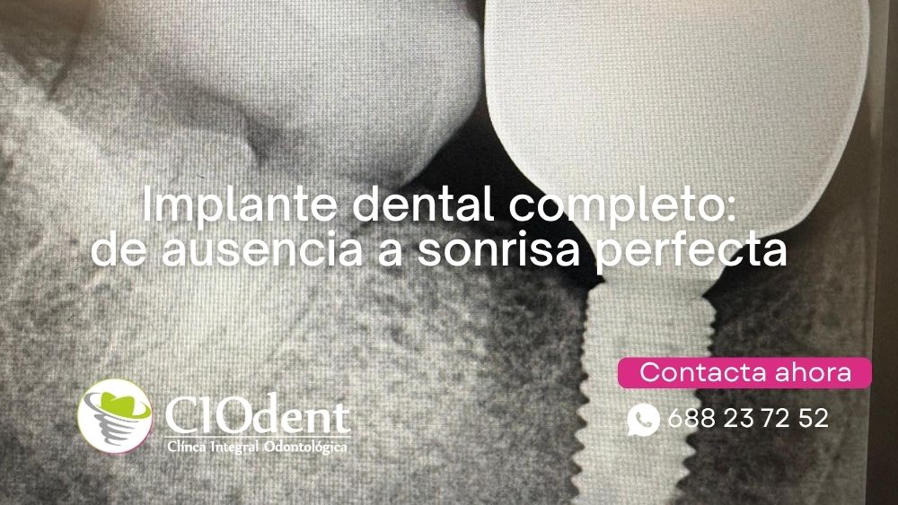 Implante dental completo: de ausencia a sonrisa perfecta