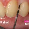 Periodoncia avanzada: detén la pérdida de encías